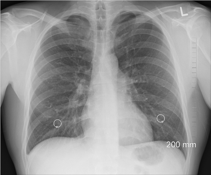 杨成：肺结节的医学探索：预防、诊断与治疗全景剖析
